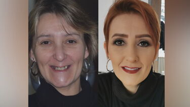 Reconstrução dentária mudou o sorriso e a vida de Susana