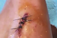 Ex-apresentadora foi suturada com três pontos numa perna 