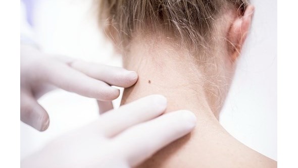 "Vale a pena suspeitar cedo, para tratar cedo", dermatologista alerta para sinais de cancro da pele 