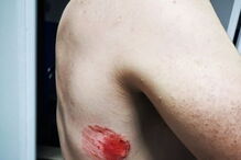 PSP mordido por cidadão com coronavírus no Cacém