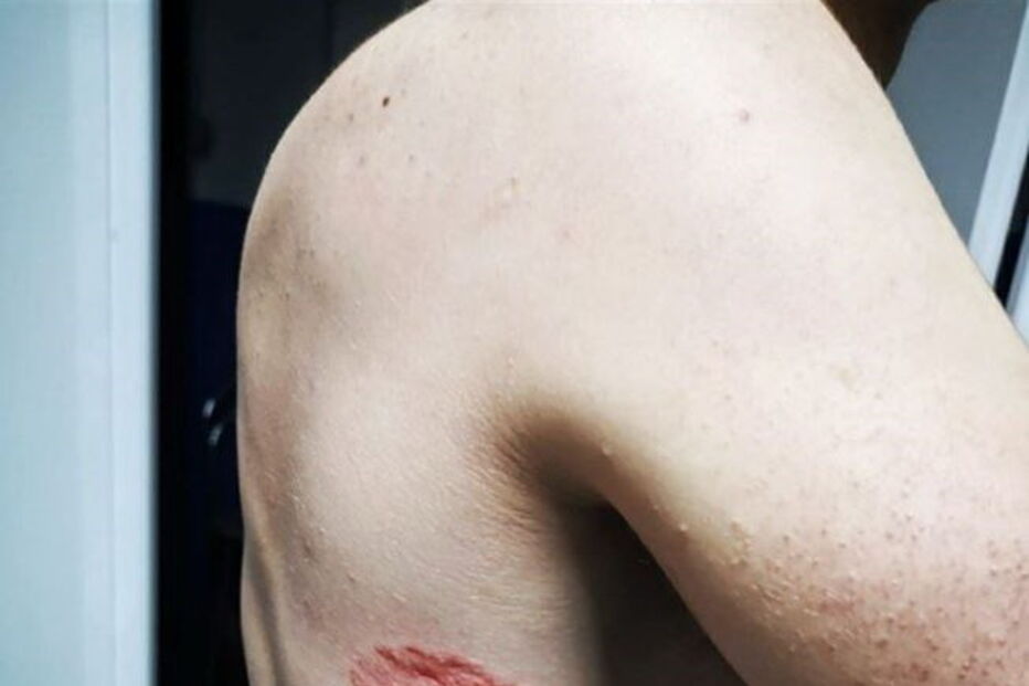 PSP mordido por cidadão com coronavírus no Cacém