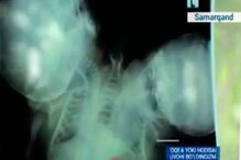 Bebé de duas cabeças nasceu no Uzebequistão