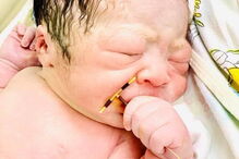 Bebé nasce com dispositivo intrauterino da mãe na mão