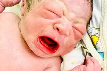 Bebé nasce com dispositivo intrauterino da mãe na mão