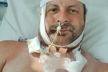 Darren tinha um tumor no maxilar