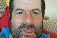 Darren tinha um tumor no maxilar