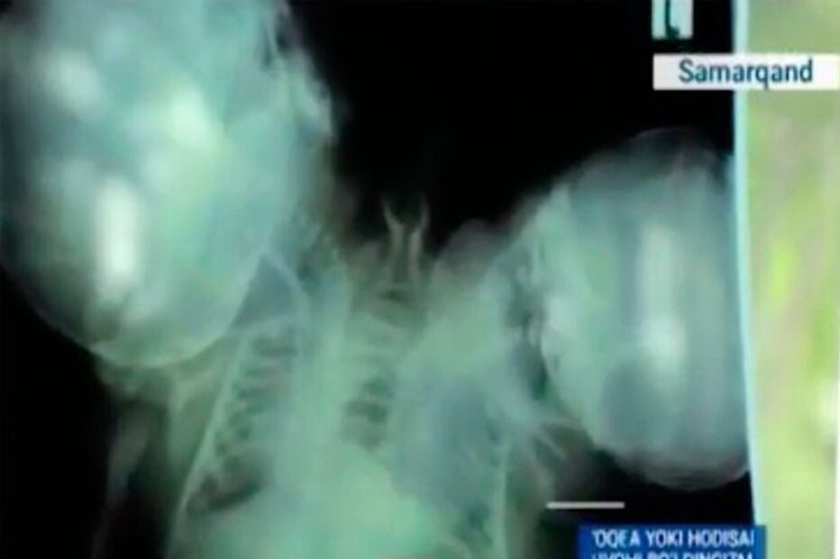 Bebé de duas cabeças nasceu no Uzebequistão