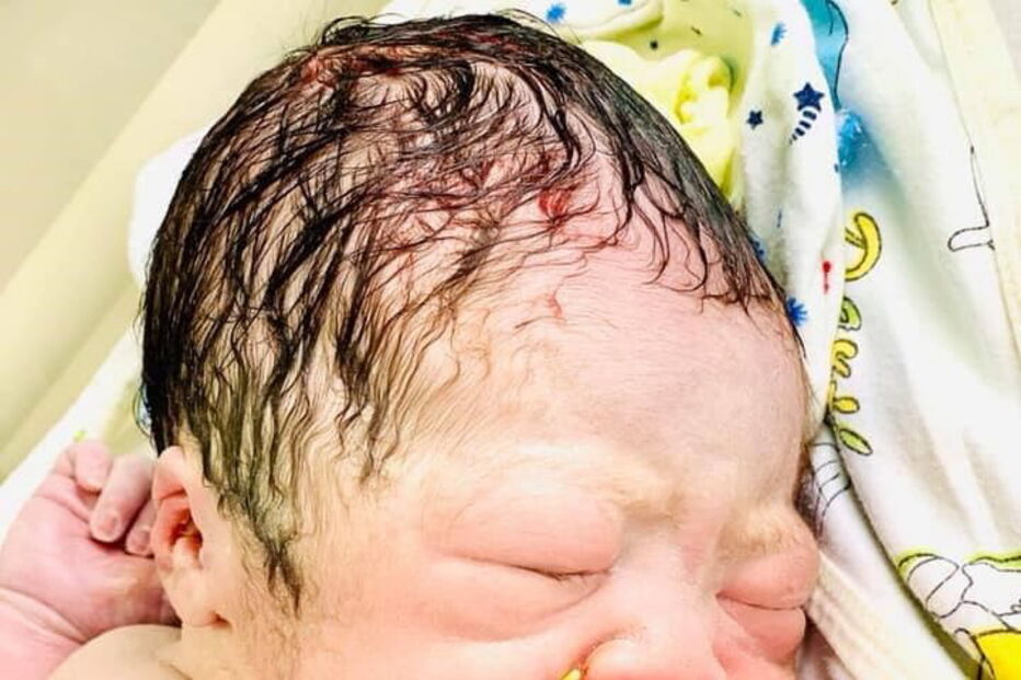 Bebé nasce com dispositivo intrauterino da mãe na mão