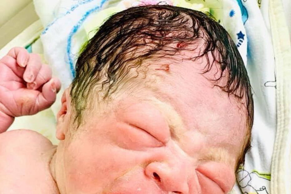 Bebé nasce com dispositivo intrauterino da mãe na mão