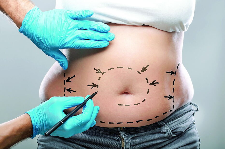 Lipoaspiração pode ser feita em várias partes do corpo onde há gordura  