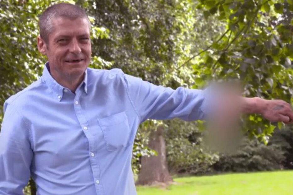 Malcom tem o pénis implantado no braço