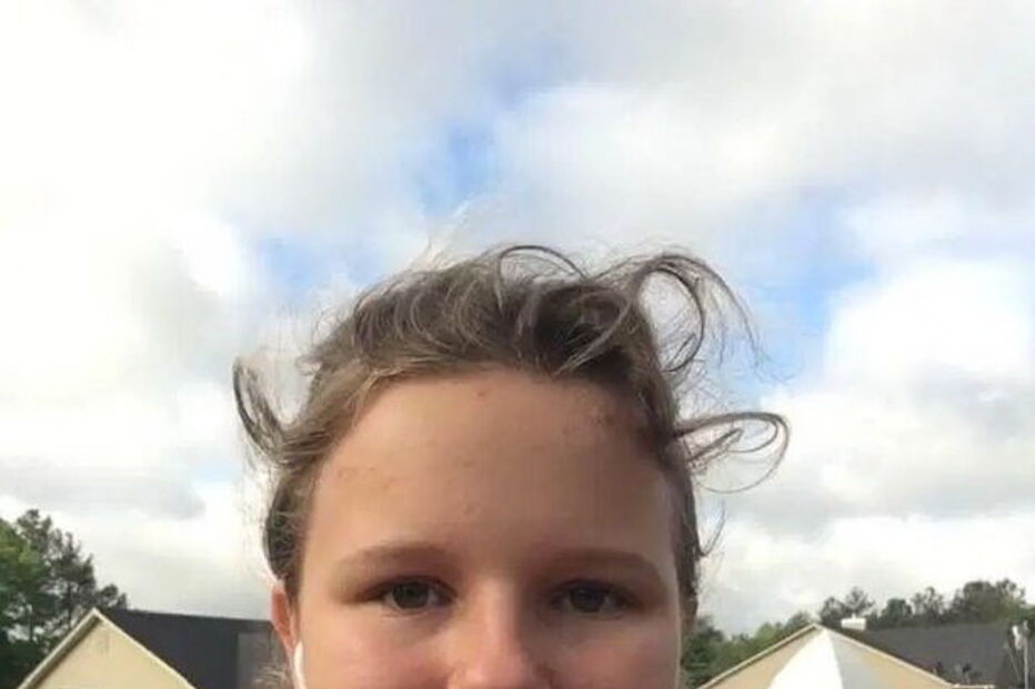 Menina de 15 anos em coma após ser atacada por dois cãos que lhe arrancaram o couro cabeludo