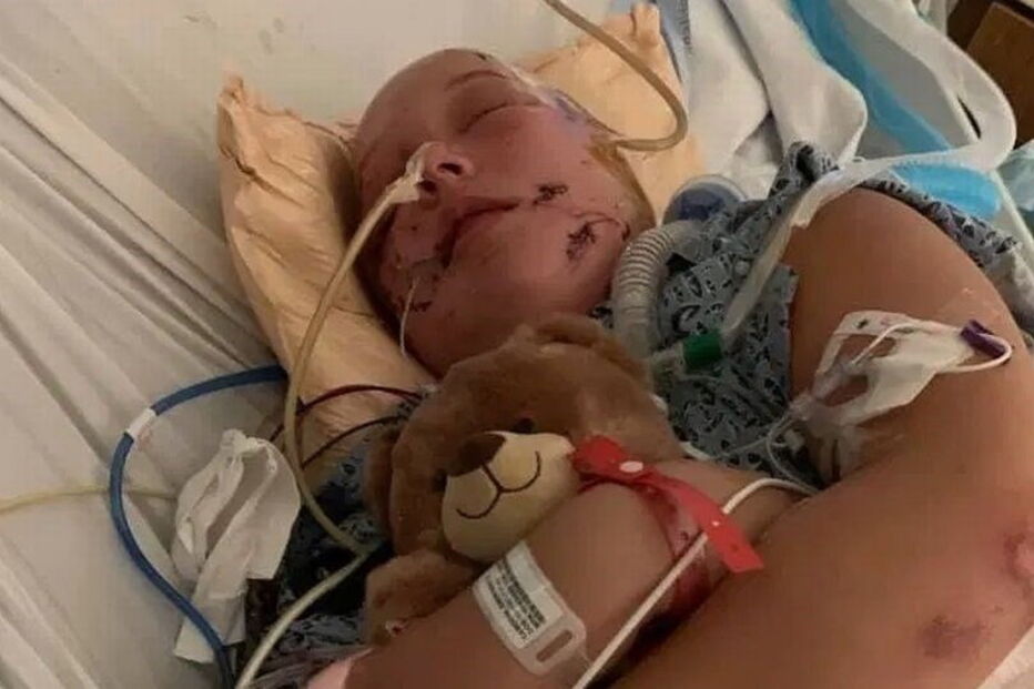 Menina de 15 anos em coma após ser atacada por dois cãos que lhe arrancaram o couro cabeludo