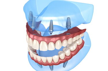 Perda de dentes e falta de osso: implantes e dentes fixos em casos extremos