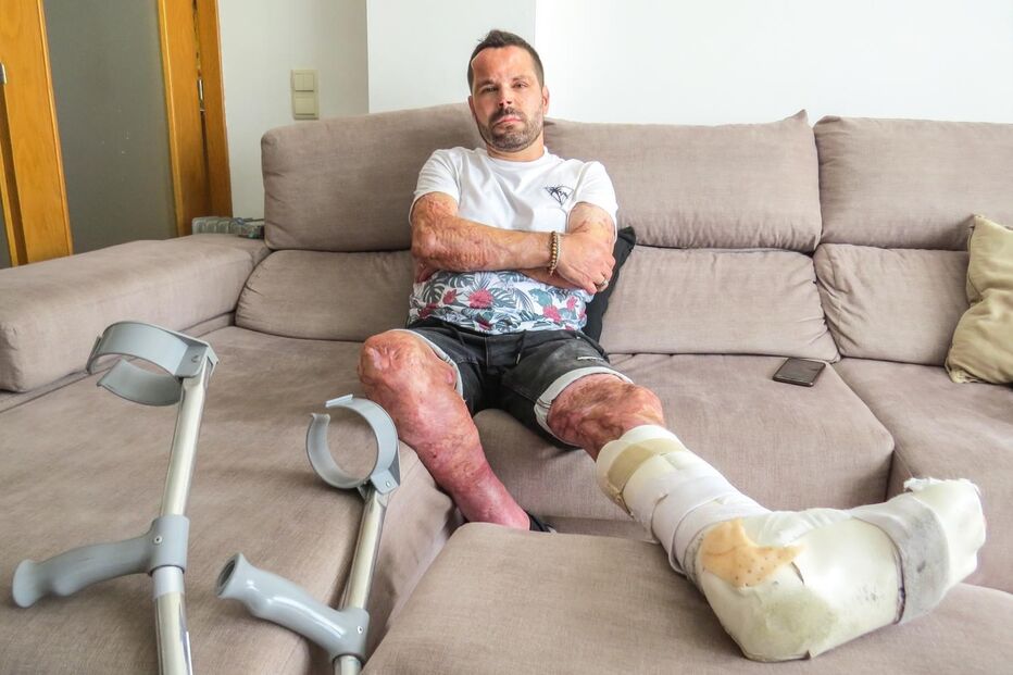 Militar da GNR relata drama vivido em incêndio que o deixou com 60% do corpo queimado