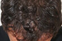 Ator Adriano Toloza faz tratamento para a queda de cabelo