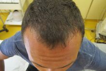 Ator Adriano Toloza faz tratamento para a queda de cabelo