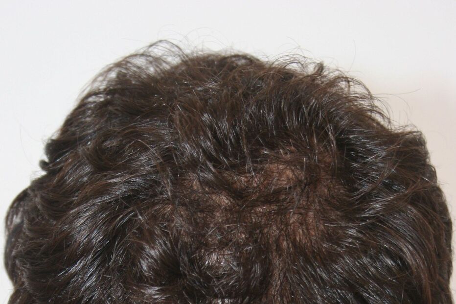 Ator Adriano Toloza faz tratamento para a queda de cabelo