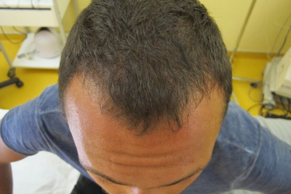 Ator Adriano Toloza faz tratamento para a queda de cabelo