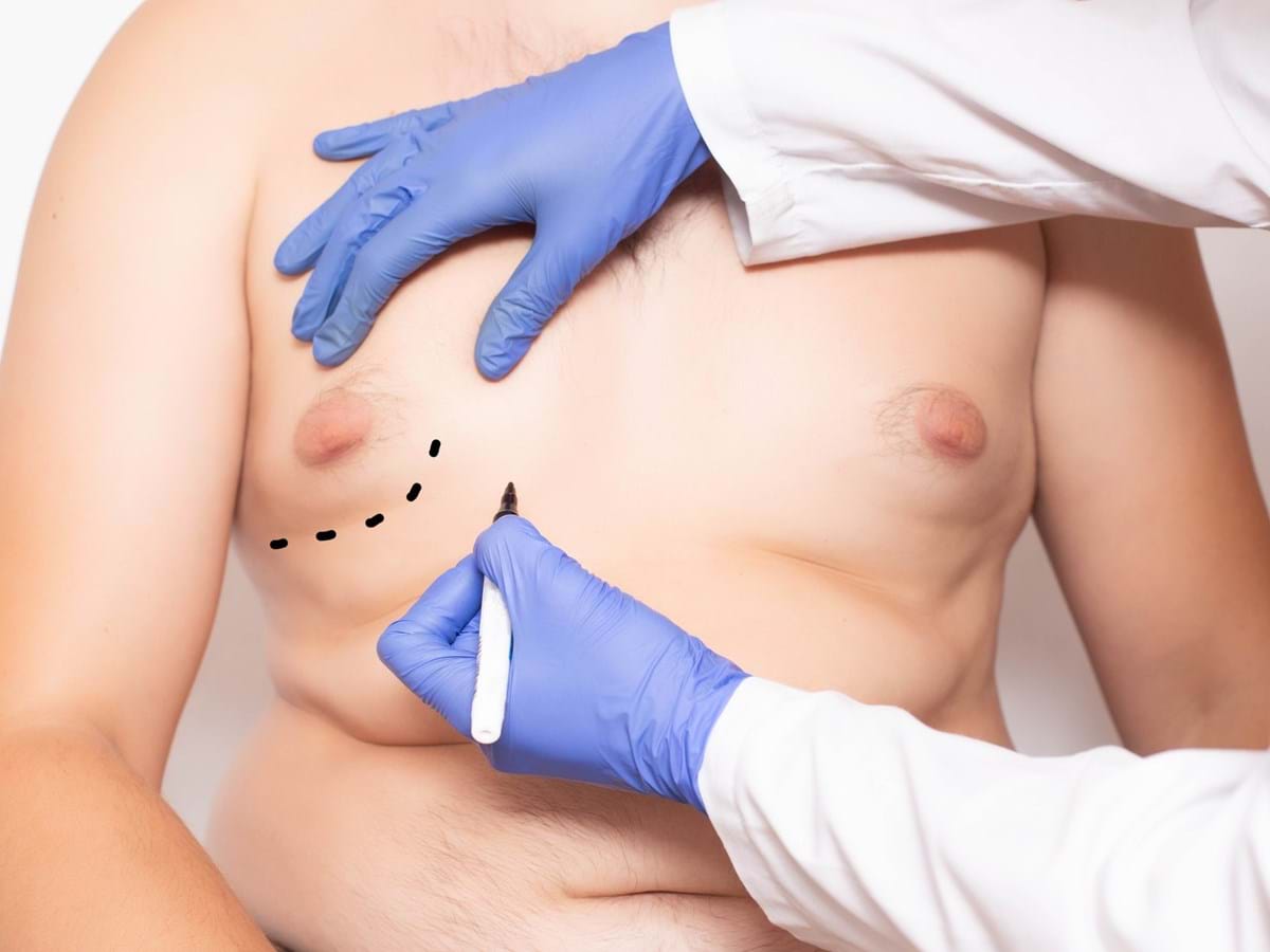 Ginecomastia o aumento da mama no homem - Trofa Saúde