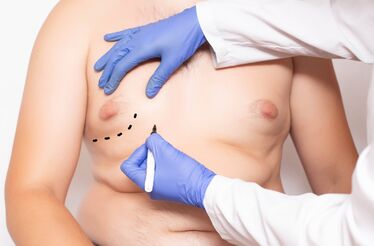 Ginecomastia: o aumento da mama no homem