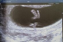 A ecografia do bebé