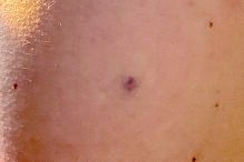 Marca de pequenas dimensões no braço da médica 