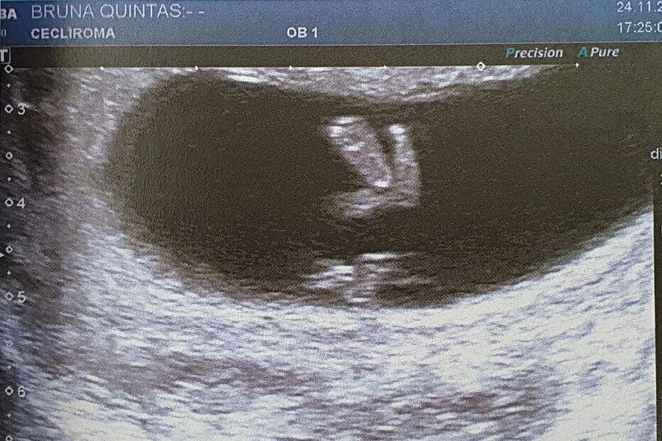 A ecografia do bebé