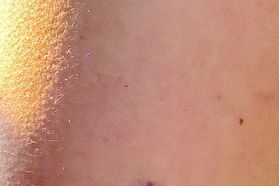 Marca de pequenas dimensões no braço da médica 