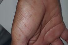 Alterações nas mãos