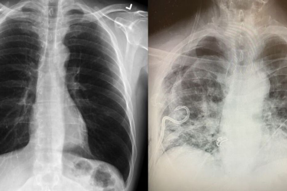Pulmões de infetado com Covid-19 ficam em pior estado de que os de um fumador