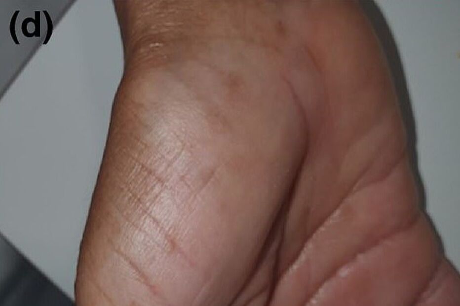 Alterações nas mãos