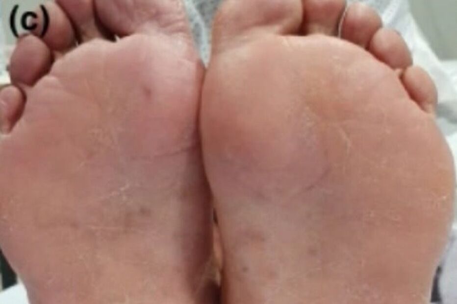 Alterações nos pés