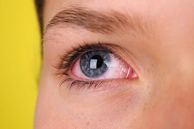 Olhos vermelhos