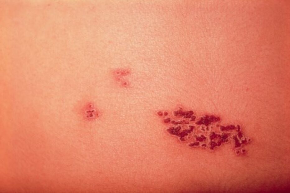 Erupções cutâneas provocadas pelo herpes zoster