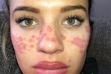 Tilly ficou com cicatrizes e marcas de queimaduras