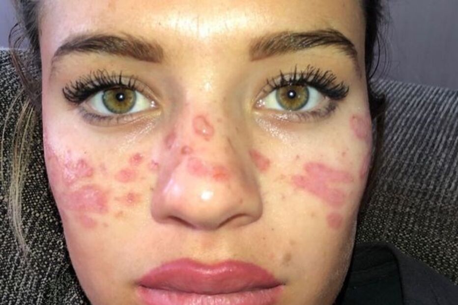 Tilly ficou com cicatrizes e marcas de queimaduras