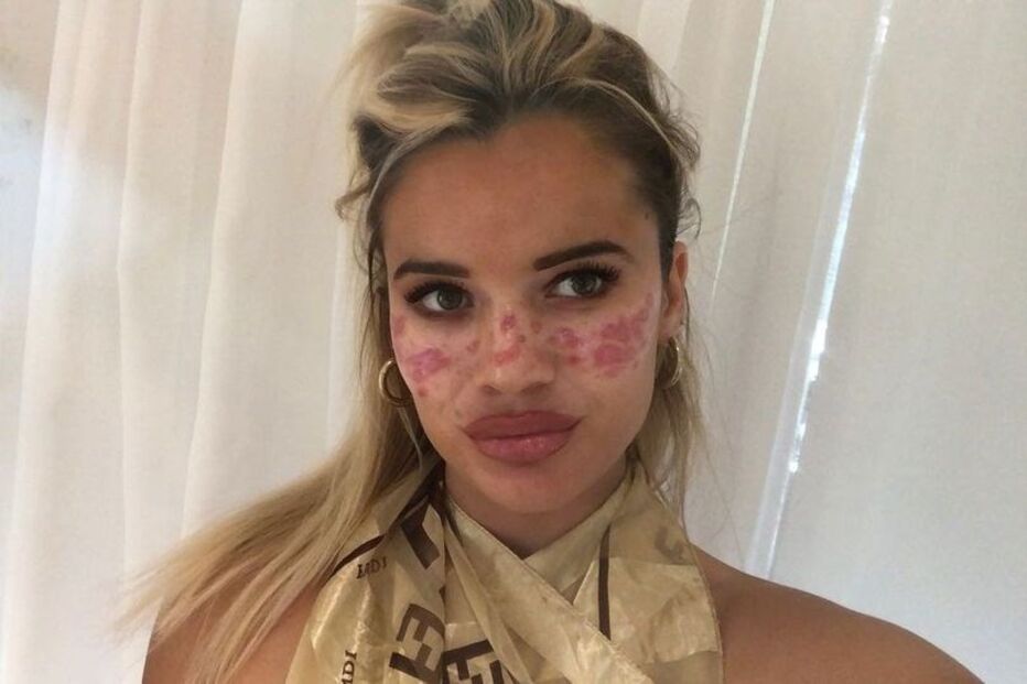 Tilly ficou com cicatrizes e marcas de queimaduras