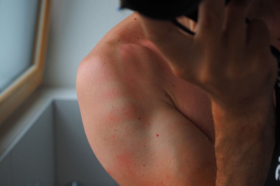 queimadura solar, escaldão