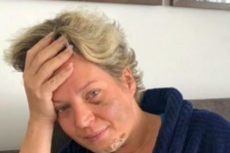 Deputada anti-Bolsonaro aparece ferida e com fraturas mas não se lembra do que aconteceu