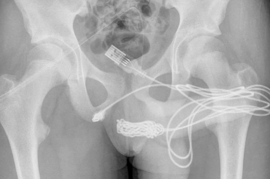 Tenta medir tamanho do pénis e acaba com cabo USB na uretra