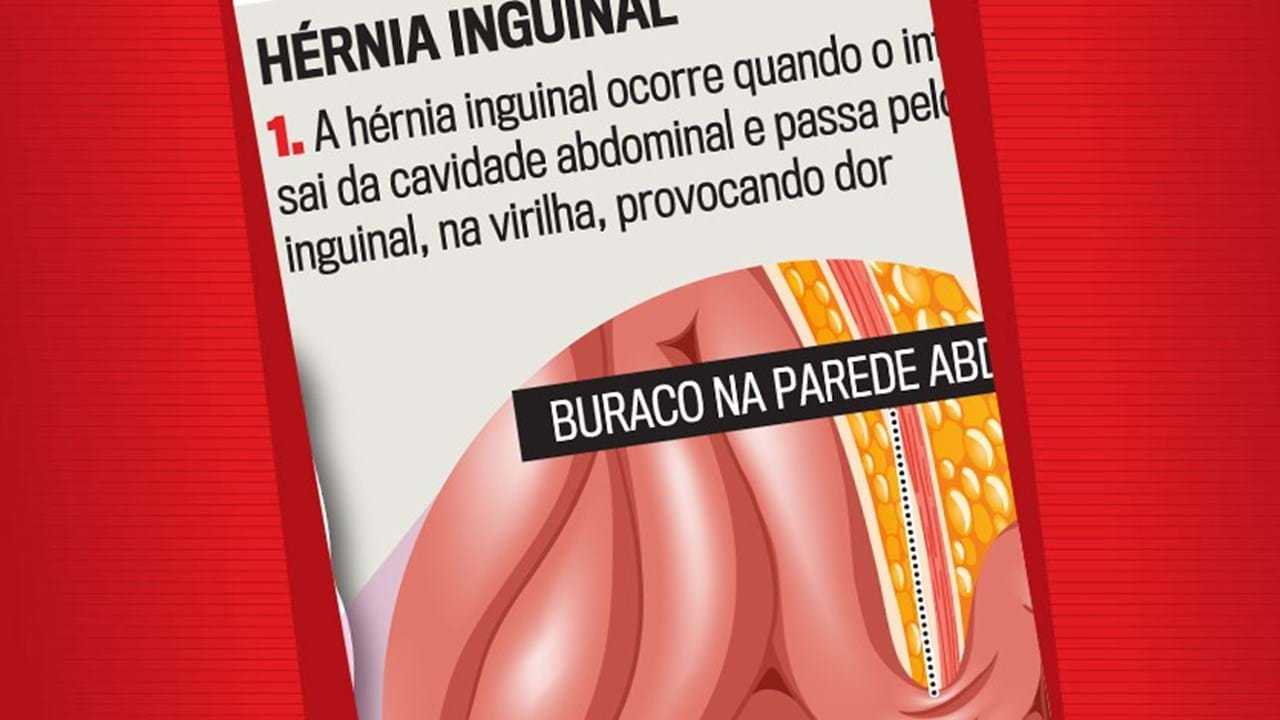 O que é uma hérnia inguinal?