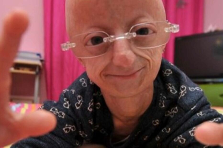 Morreu Cláudia Amaral, a menina com 23 anos que parecia ter 100