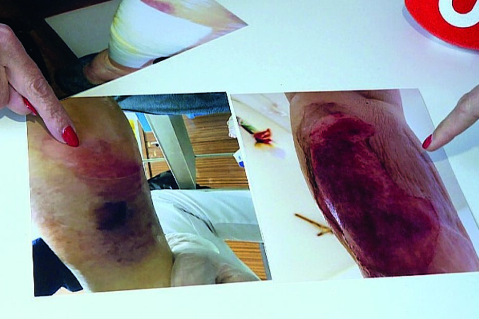 Lesão na perna da idosa de 95 anos