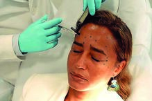 Liliana Almeida durante o procedimento estético