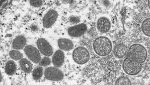 Sobe para 58 o número de casos de varíola dos macacos em Portugal
