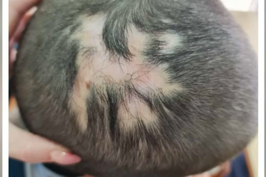 Criança alvo de bullying em Lisboa por ter falta de cabelo