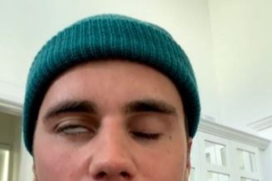 Paralisia de Justin Bieber