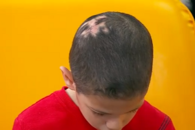 Duarte sofre de bullying e precisa de um implante capilar