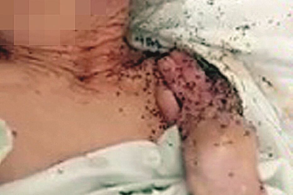 Florinda Queiroz morreu aos 86 anos. Imagens mostram formigas numa ferida e a subirem para a cama onde estava